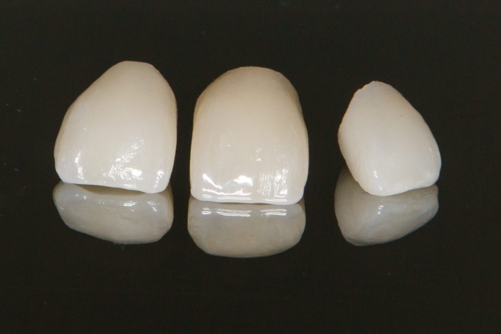 Ceramic Dental Crowns